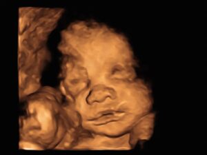 3d ultrasound